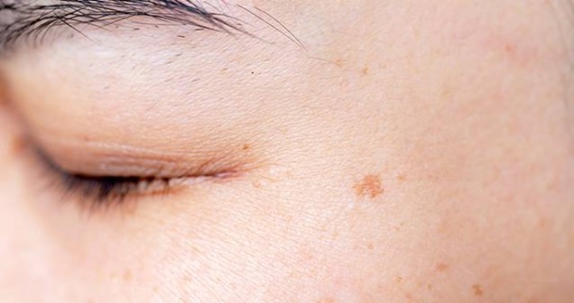 Ciltteki Siyah Lekeler Nasıl Yok Edilir? Etkili Yöntemler ve Bakım Önerileri